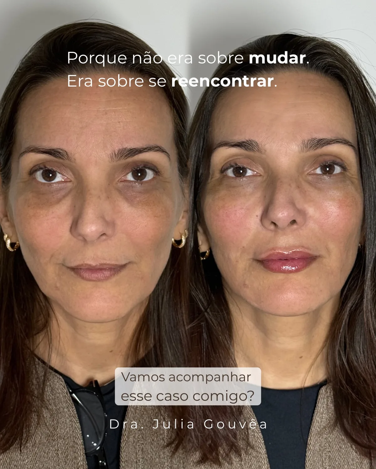 Harmonização facial