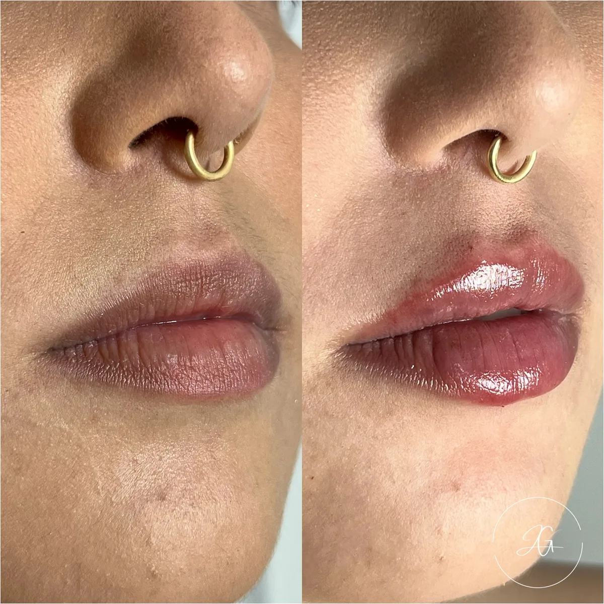 Preenchimento labial, resultado 1