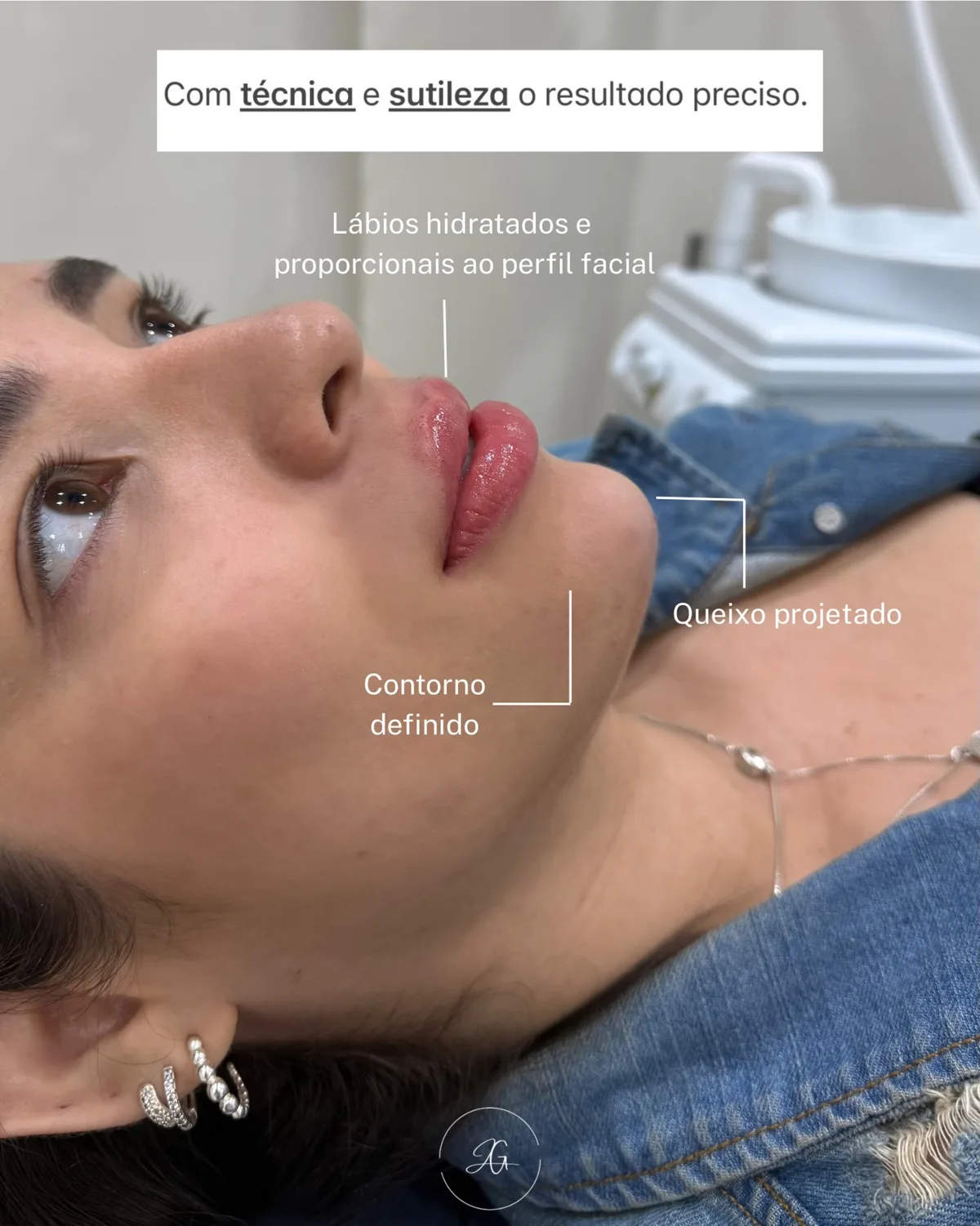 Preenchimento labial, resultado 10