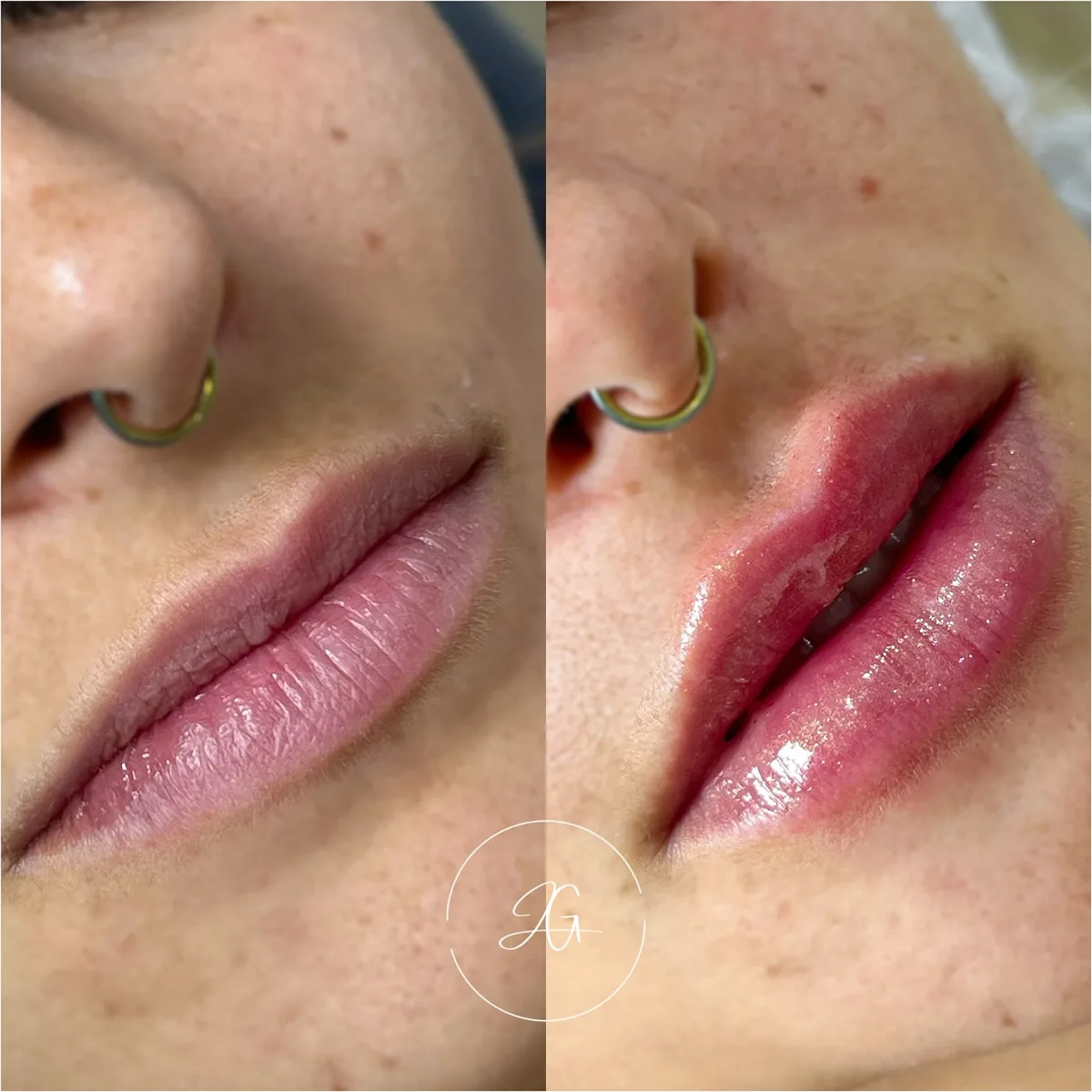 Preenchimento labial, resultado 2