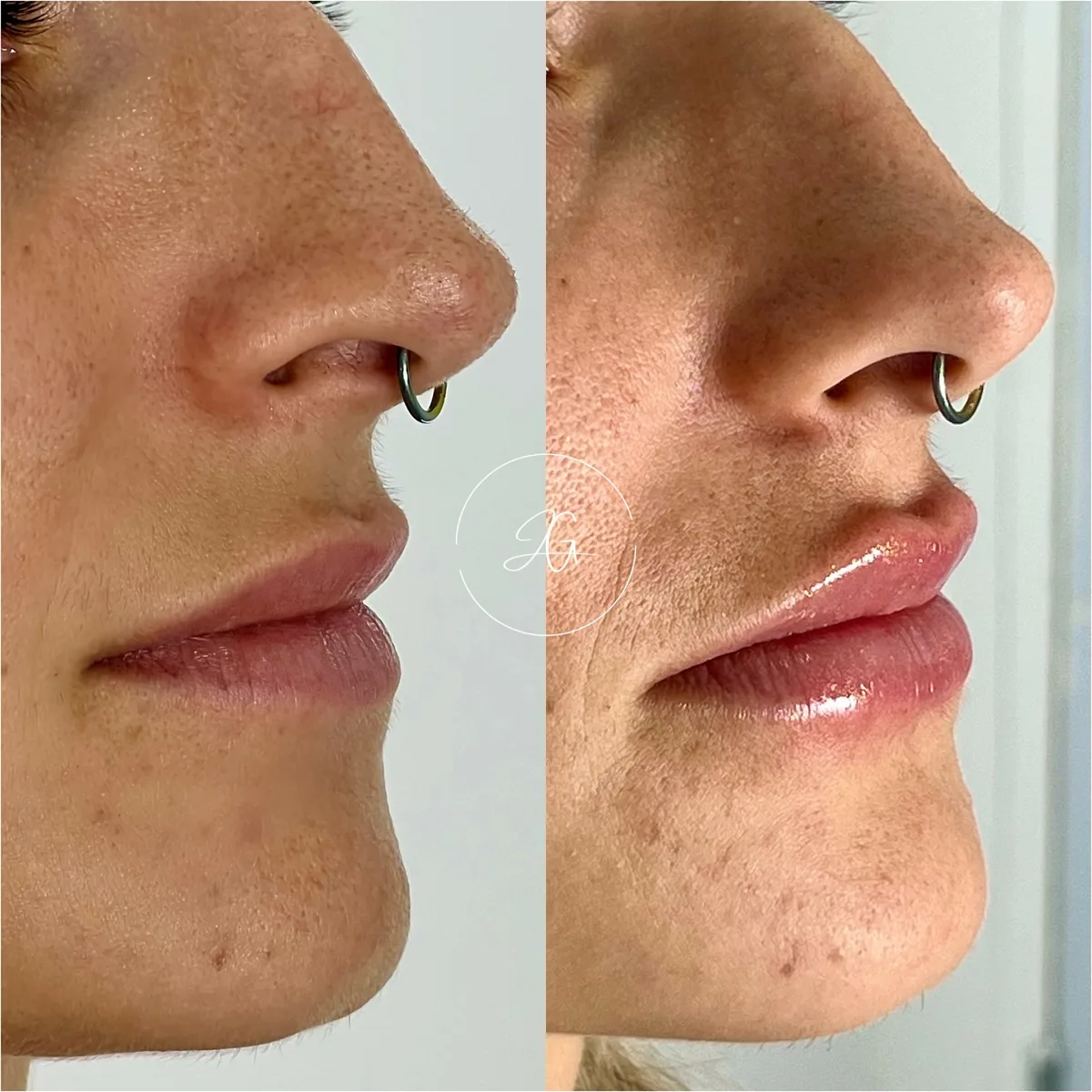 Preenchimento labial, resultado 3