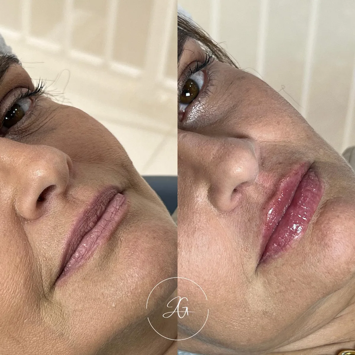 Preenchimento labial, resultado 4