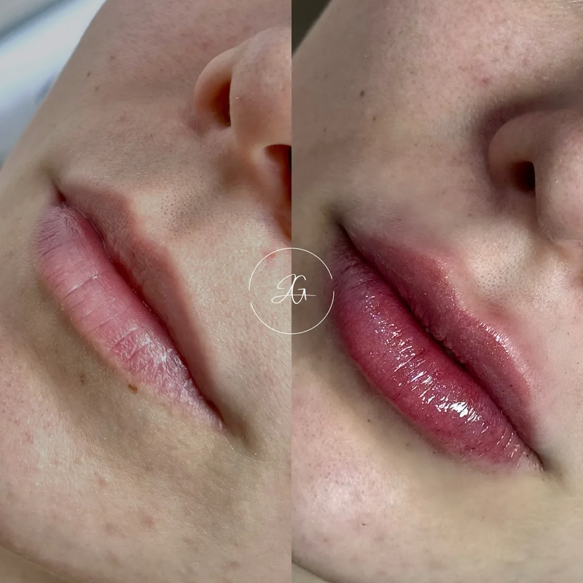 Preenchimento labial, resultado 5