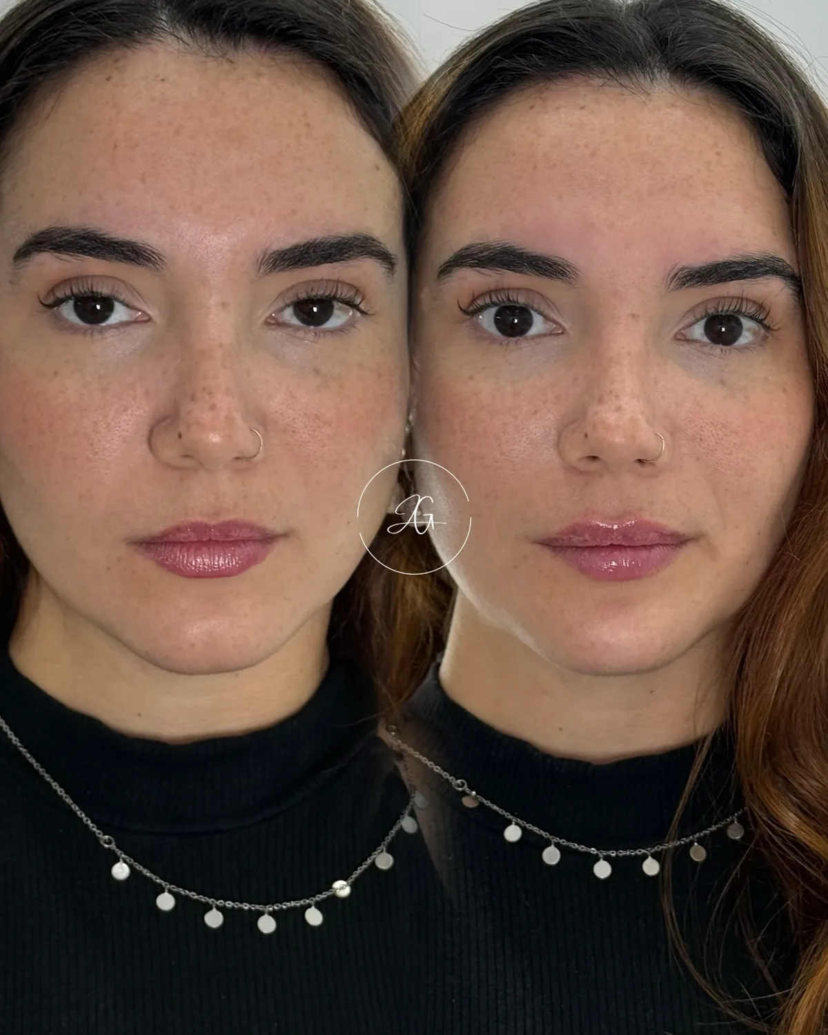 Preenchimento labial, resultado 6