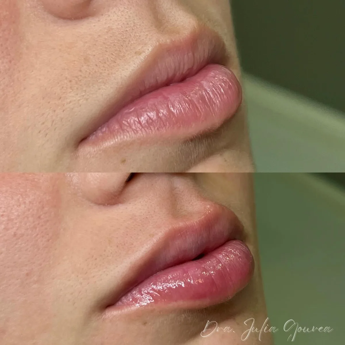 Preenchimento labial, resultado 7