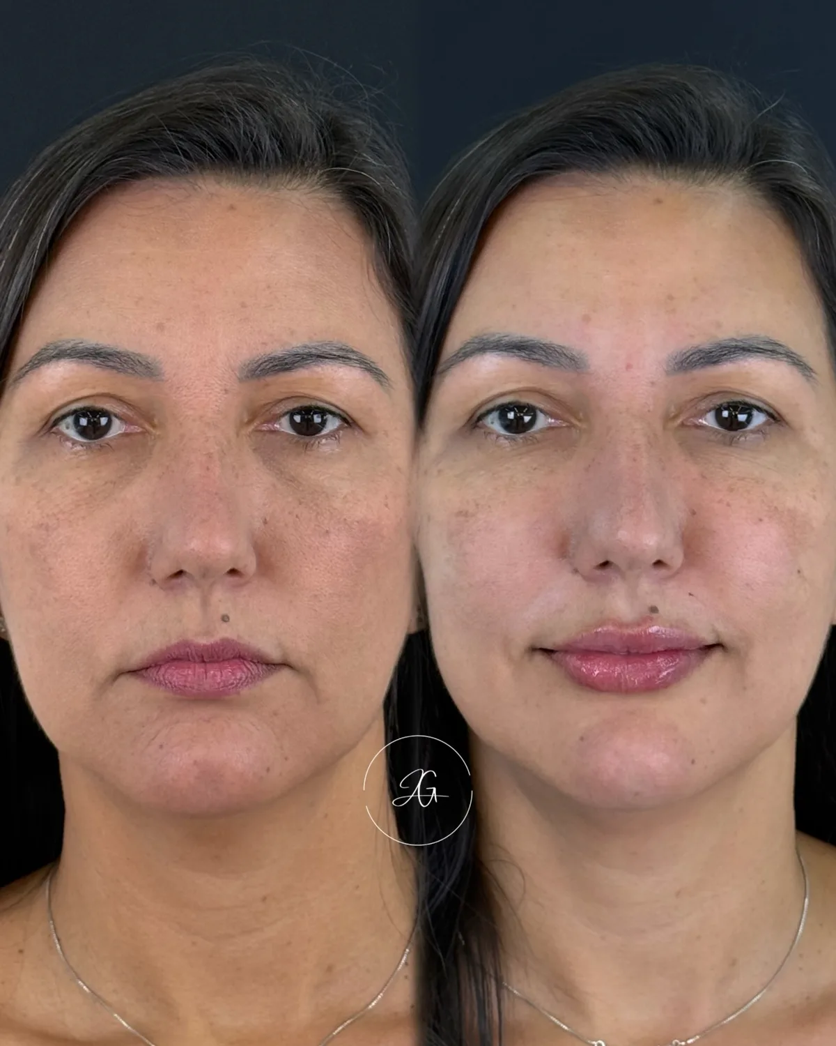 Preenchimento labial, resultado 8