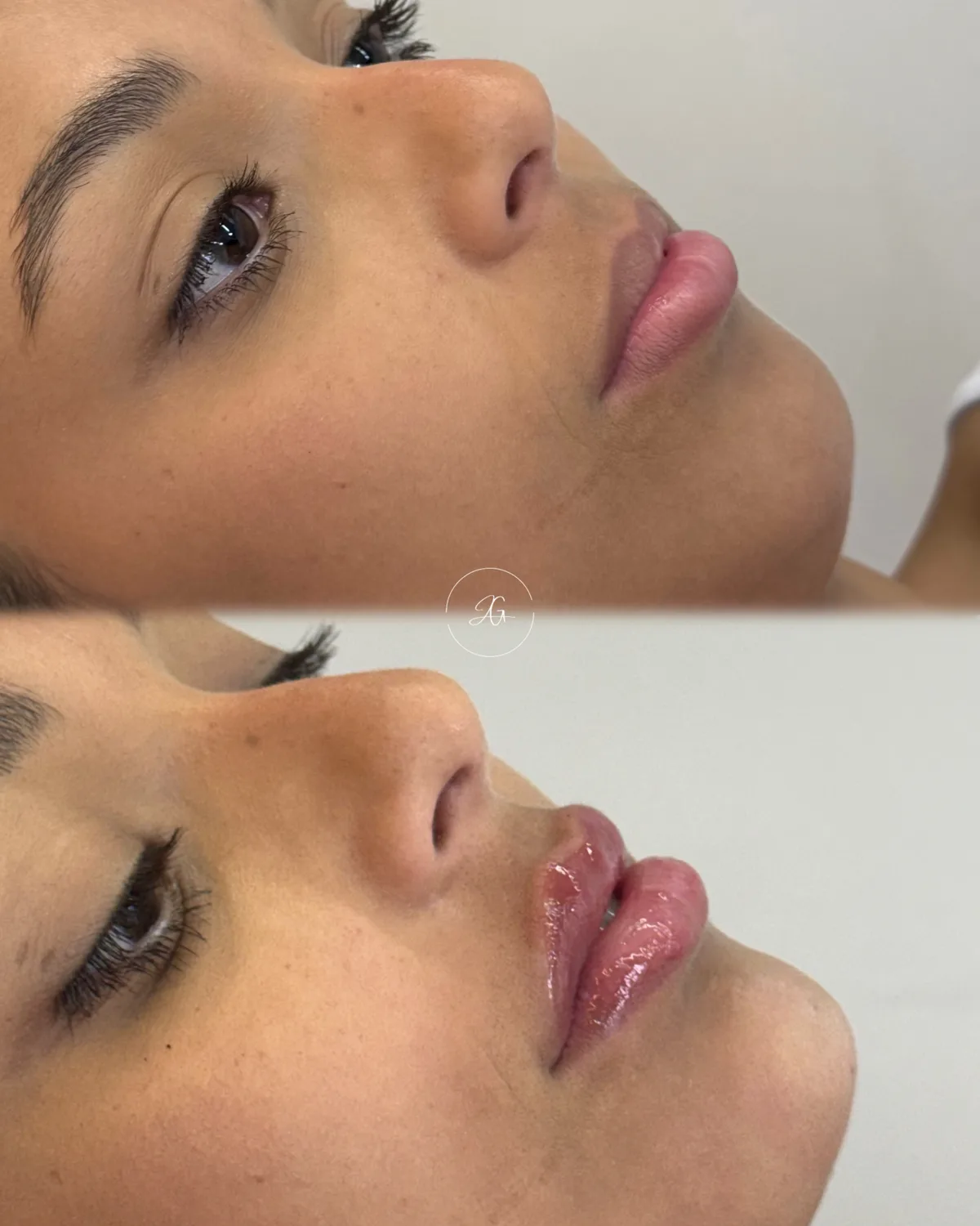 Preenchimento labial, resultado 9